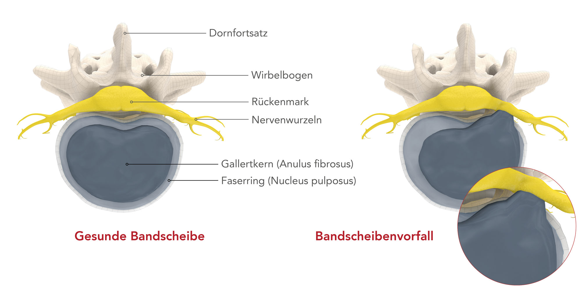 Bandscheibenvorfall