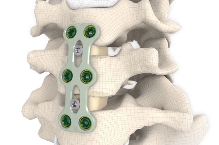 cervical, disc prosthesis, motion preservation