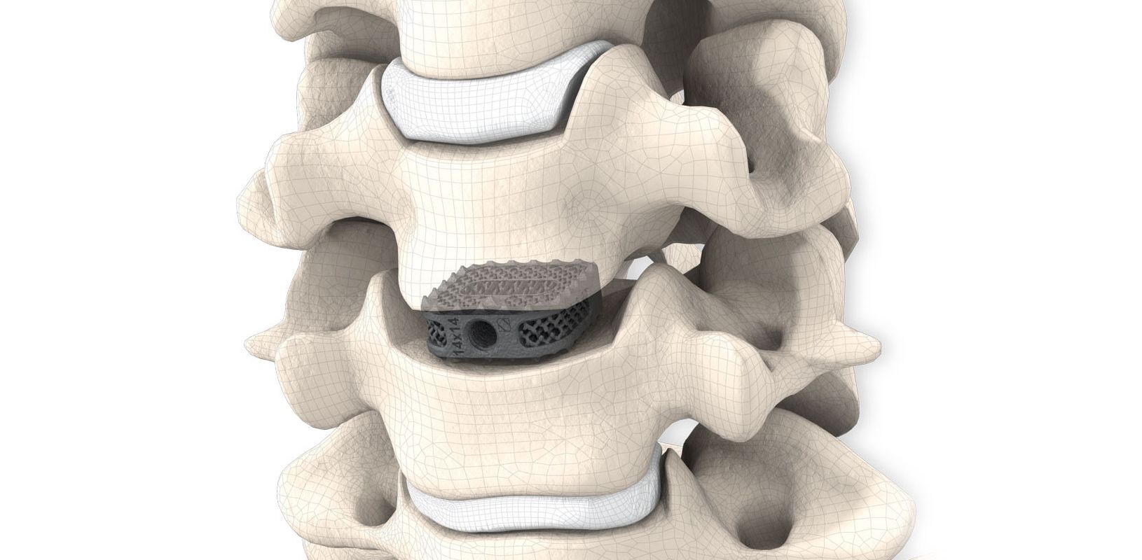 JASPIS® ST, CE Zulassung, HWSCage, Implantat, additiv gefertigt