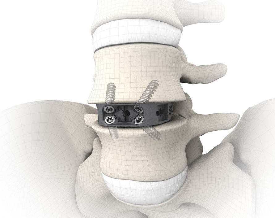 ALIF, Cage, Fusion, ST-Line, Anterior, Lumbar