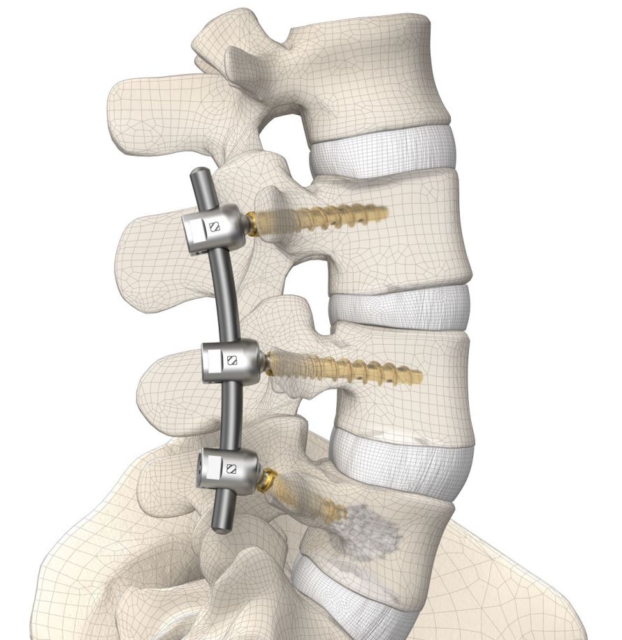 posterior, screw-rod-system, tulip, augmentable