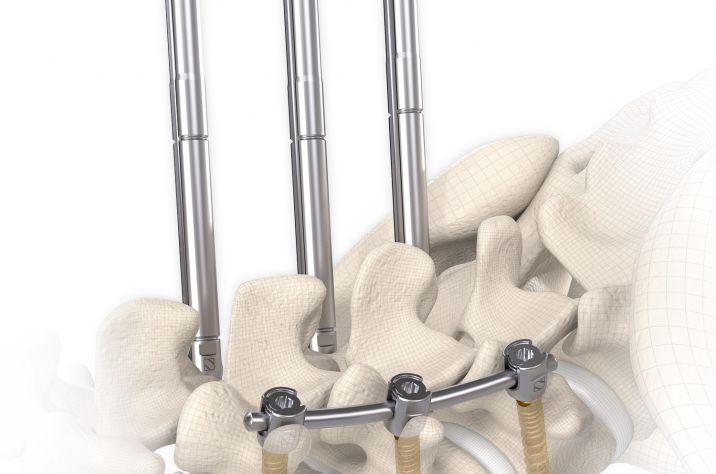 Signus Threaded Rod posterior, screw-rod-system, tulip, augmentable