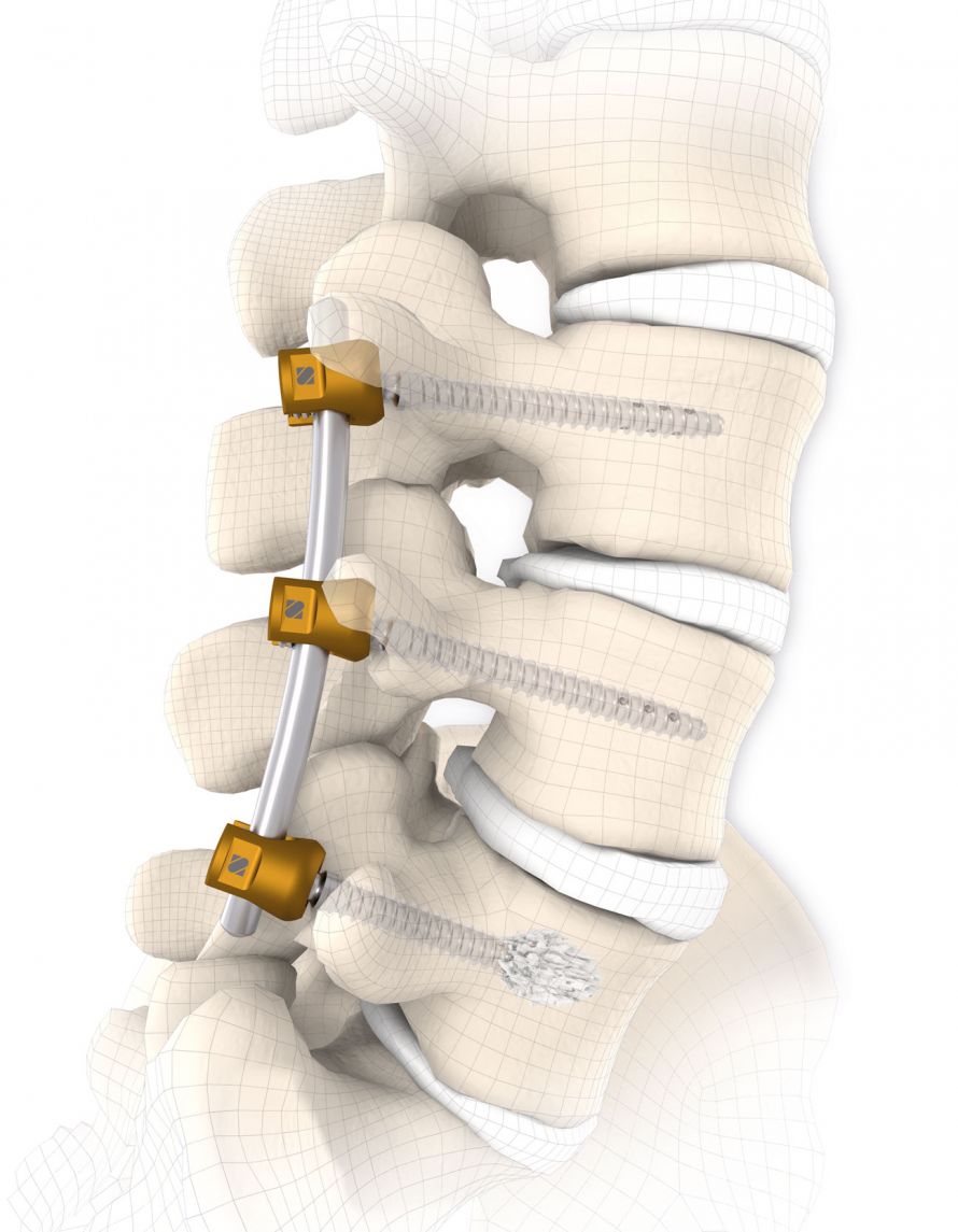 Signus Threaded Rod posterior, screw-rod-system, tulip, self-tapping
